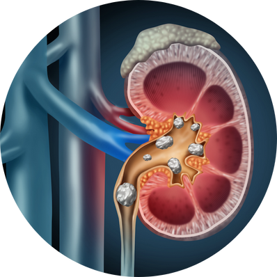 Mini-PCNL