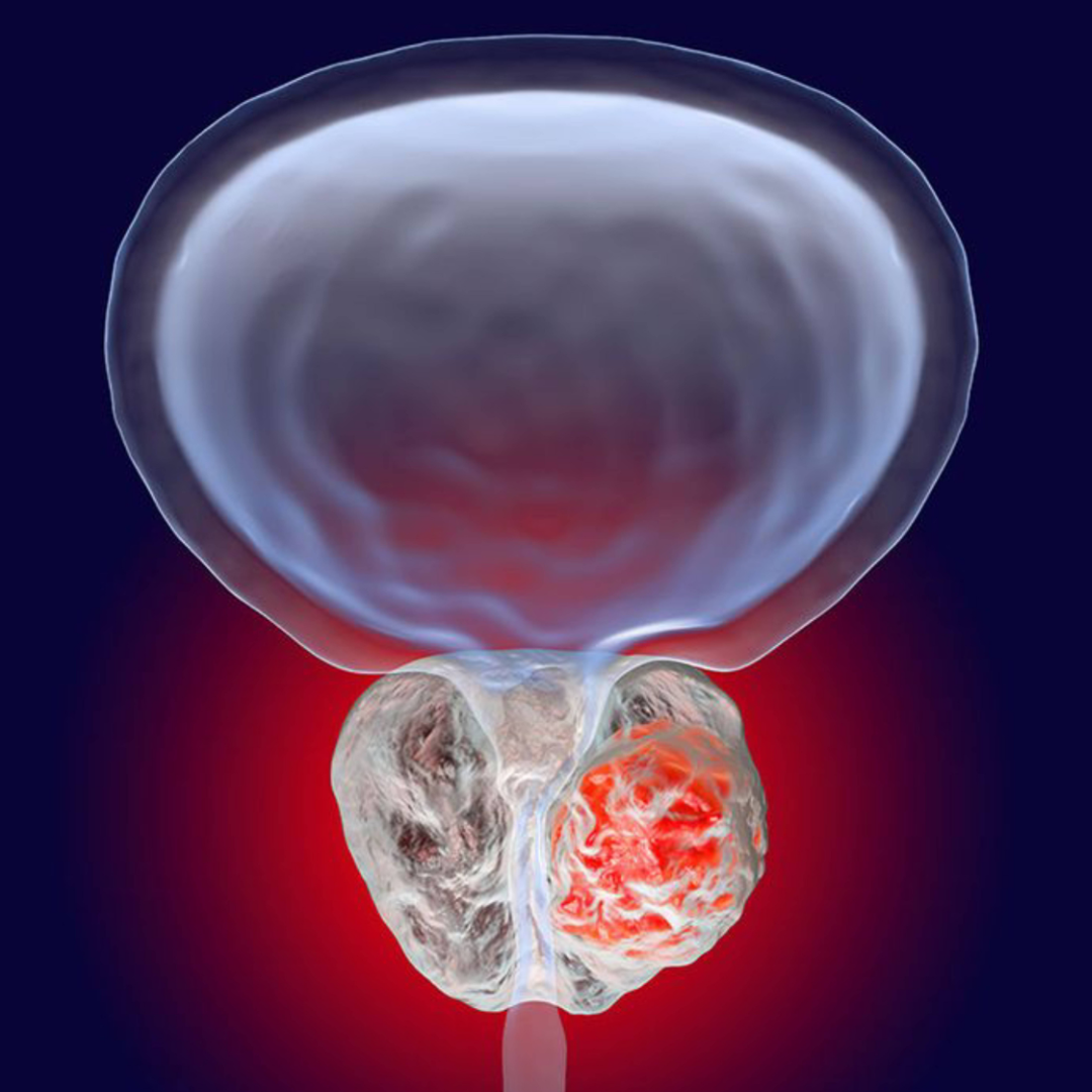 Large or multiple bladder tumors