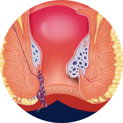 Prolapsed Haemorrhoids