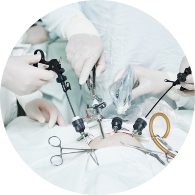 Laparoscopic Cystectomy