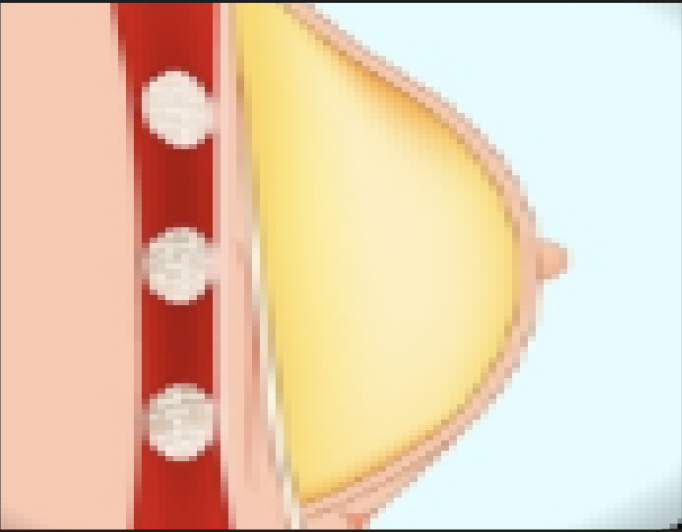 Firm or rubbery tissue under the nipple