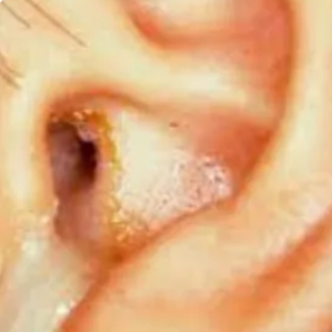 Drainage of pus from the ear (chronic suppurative otitis media)