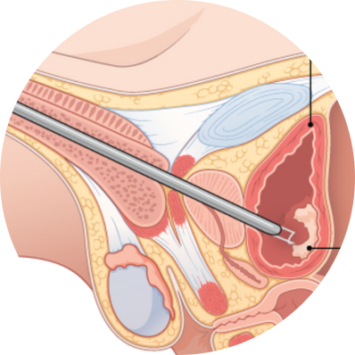 Diagnostic TURBT