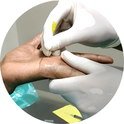 Percutaneous Release