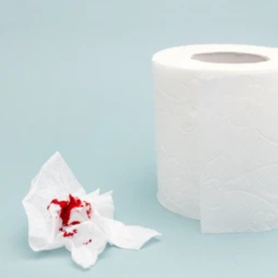 Bright red blood on stool or toilet paper