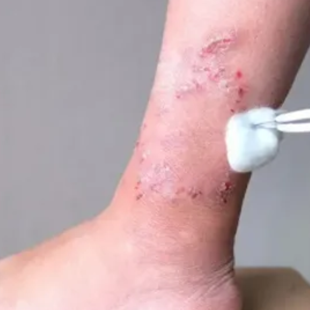 Delayed healing due to poor blood supply
