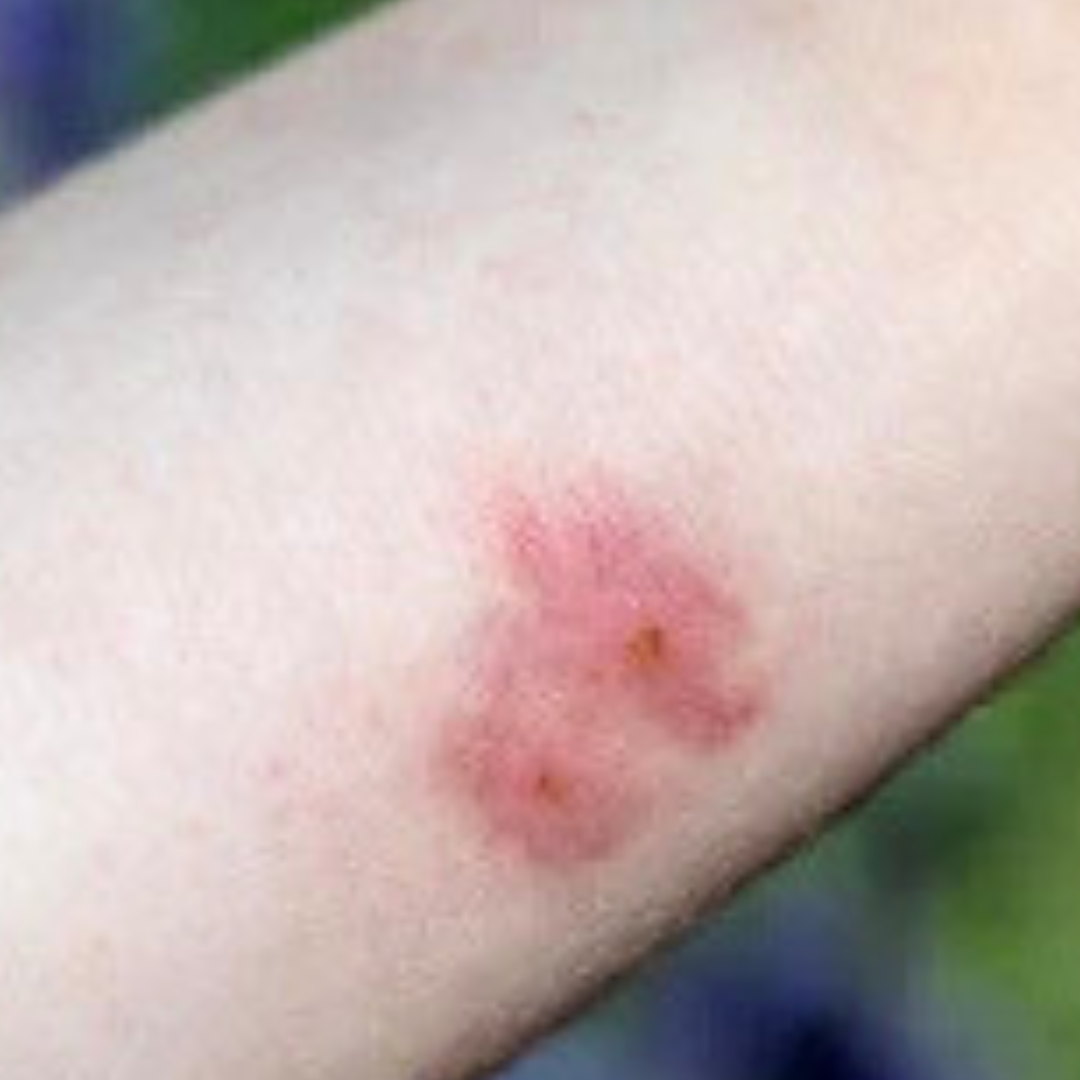 A small skin tag (sentinel pile) near the fissure in chronic cases