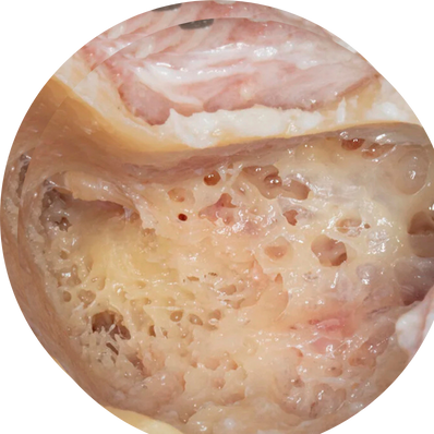 Simple (Closed Cavity) Mastoidectomy