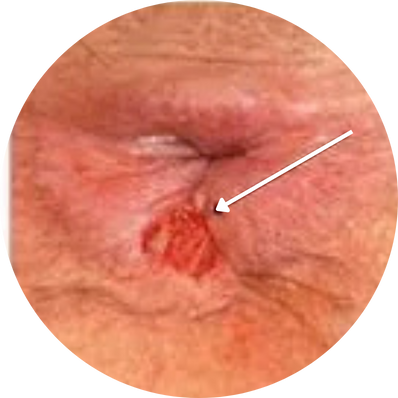 Acute Fissure