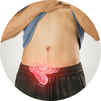 Inguinal Hernia
