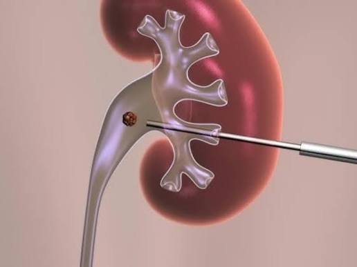 PCNL Surgery