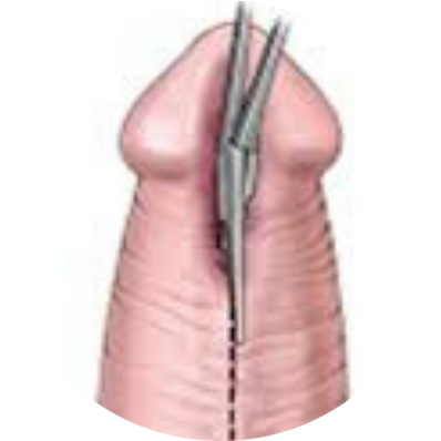 Excision and Primary Anastomosis (EPA)