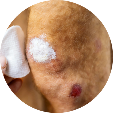 Enzymatic Debridement