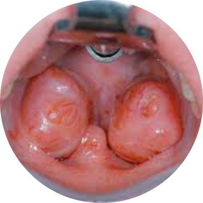Partial tonsillectomy