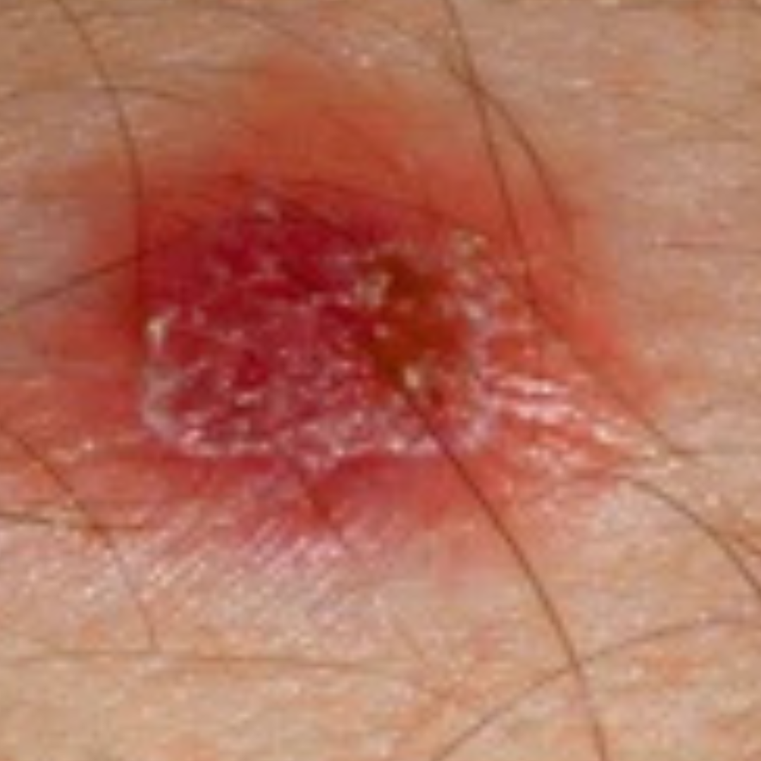 Rare suspicion of liposarcoma (malignant tumor)