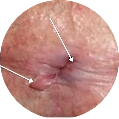Chronic Fissure