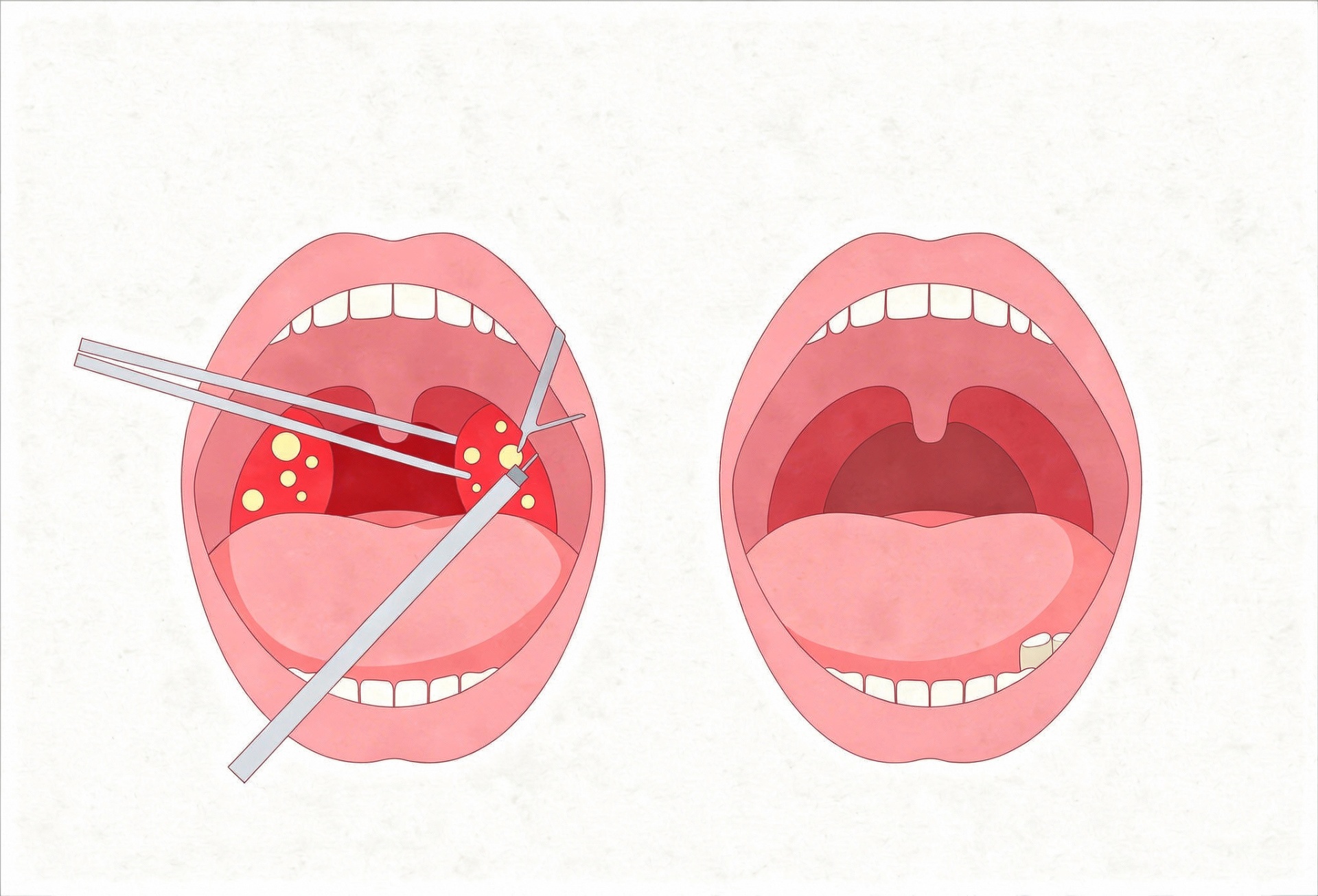 Tonsillectomy