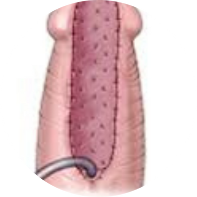 Staged Urethroplasty