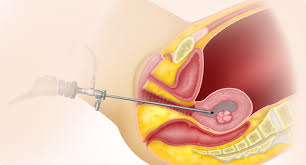 Retained products of conception