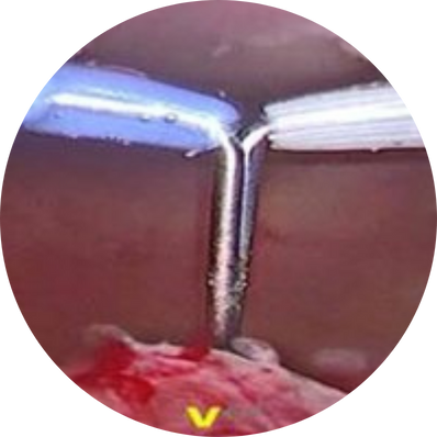 Bipolar TURP