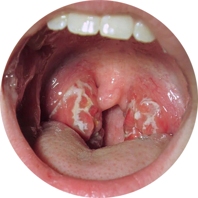Recurrent Group A streptococcal infection