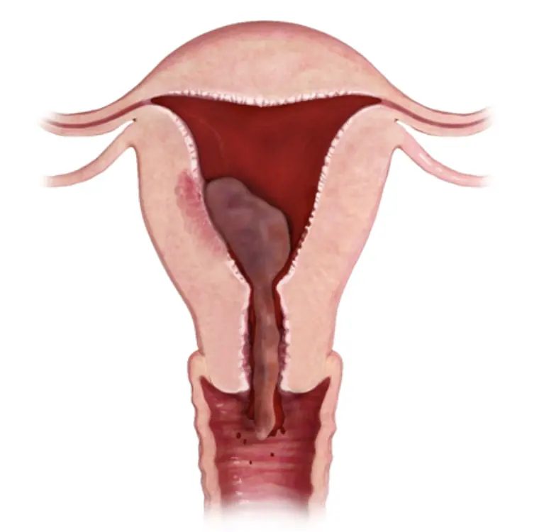 Incomplete miscarriage with retained tissue