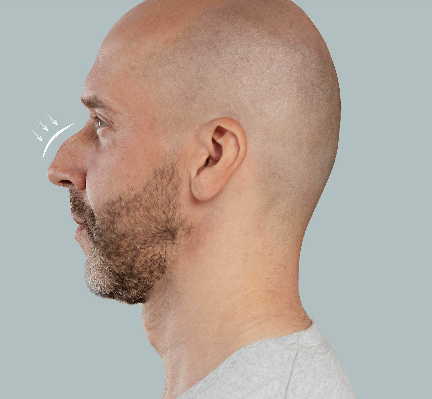 Nasal Bone Repair