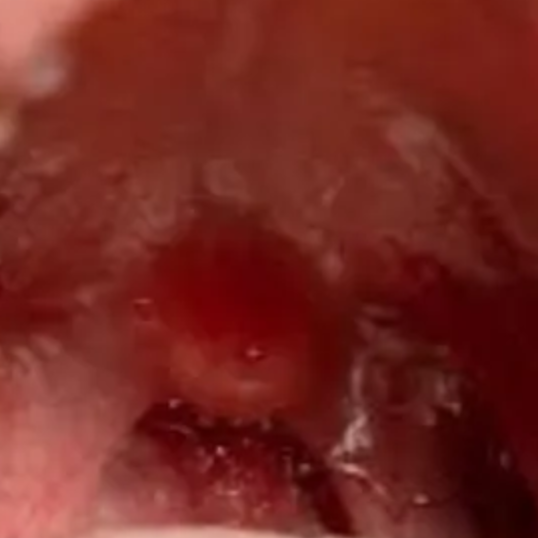 Difficulty swallowing due to enlarged tonsils