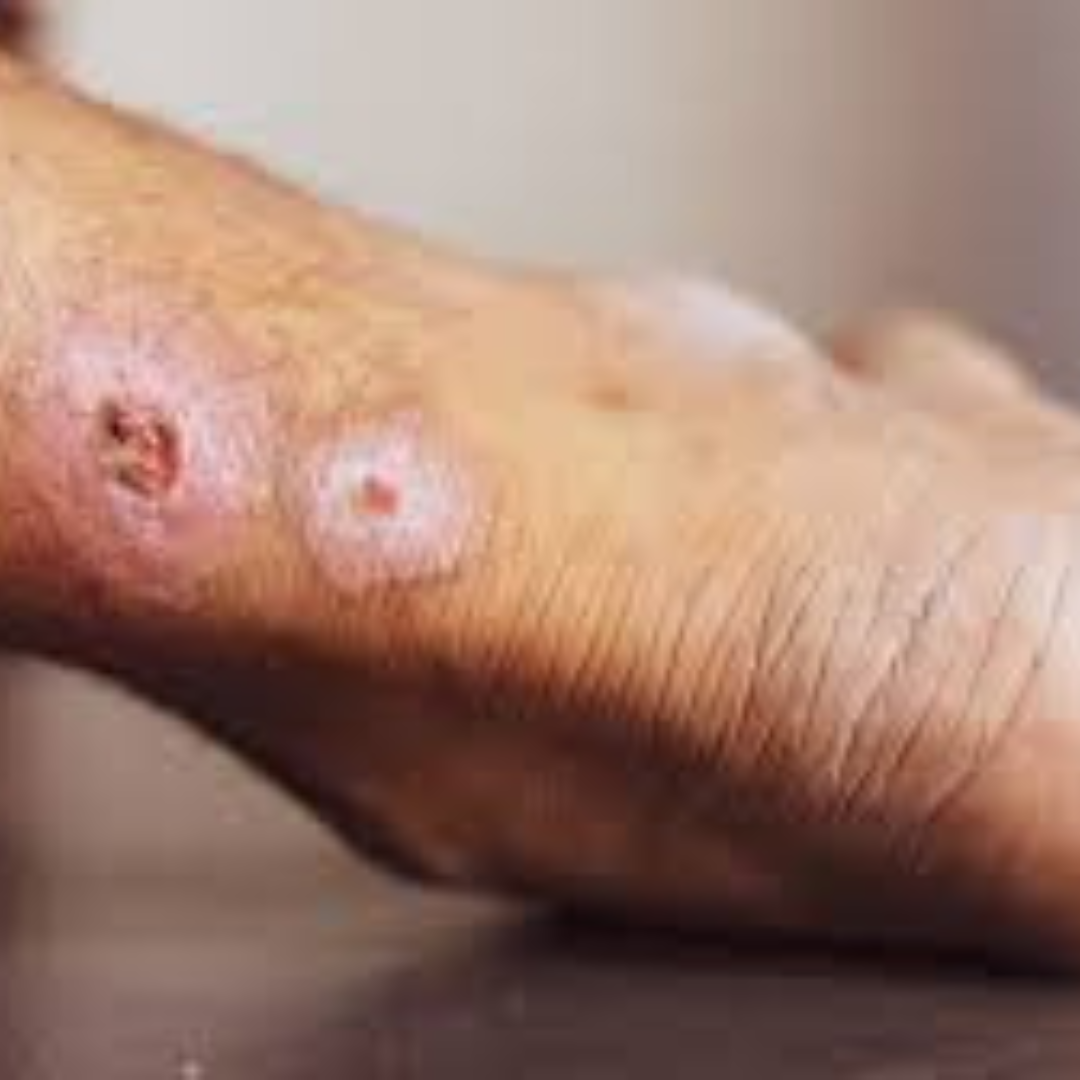 Non-healing ulcer of the leg