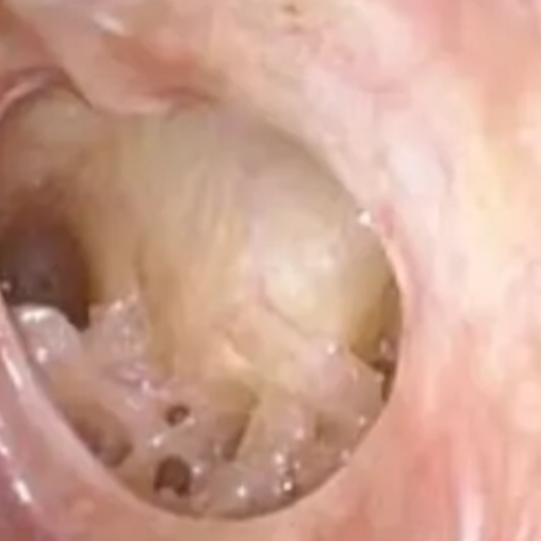 Persistent hole in the eardrum not healing on its own