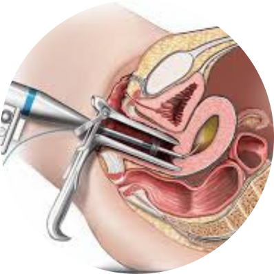 Electrosurgical Ablation
