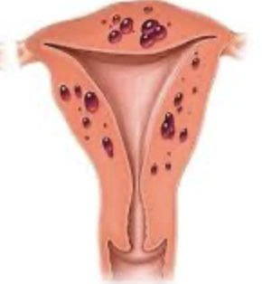 Adenomyosis (uterine lining grows into muscle)