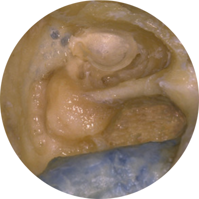 Radical (Open Cavity) Mastoidectomy