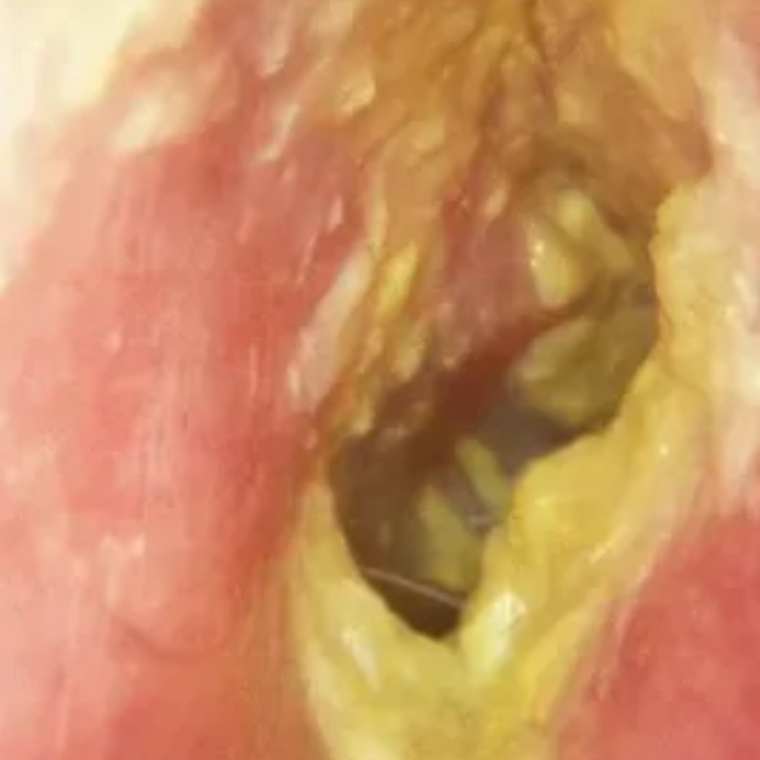 Persistent or recurrent ear infections not responding to medication