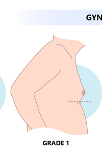 Pure Glandular Gynecomastia
