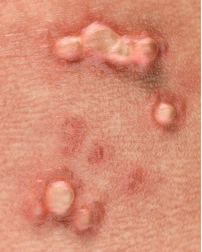 Complete removal of visible warts