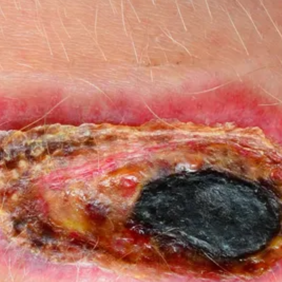 Presence of necrotic (dead) tissue