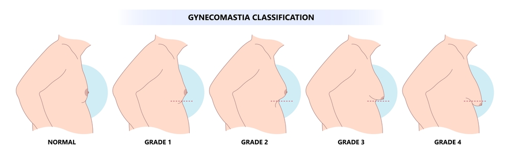 Normal Gynecomastia