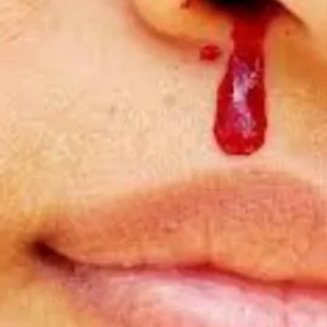 Bleeding from the nose