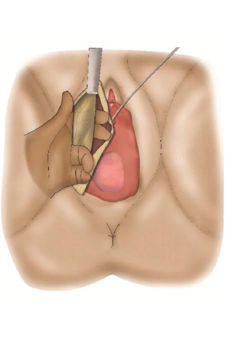 Urethroplasty