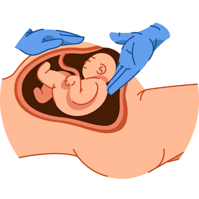 Planned C-section