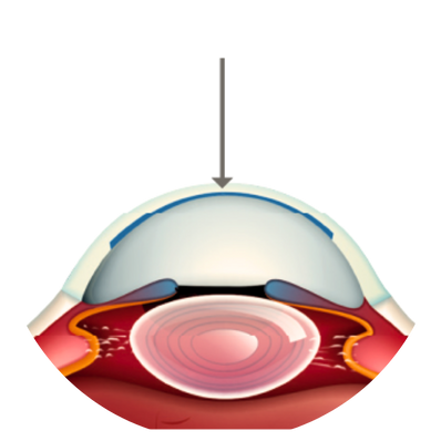Lamellar Keratoplasty (DALK / DSAEK / DMEK)